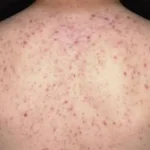 Viêm Nang Lông: Giải Mã Nguyên Nhân & Cách Điều Trị Dứt Điểm Theo Đông Y 1