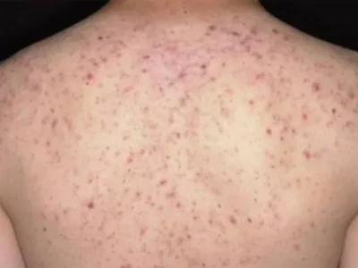 Viêm Nang Lông: Giải Mã Nguyên Nhân & Cách Điều Trị Dứt Điểm Theo Đông Y