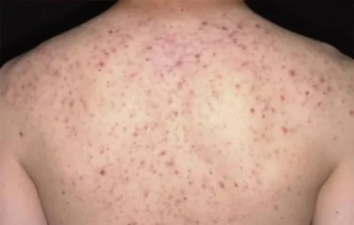 Viêm Nang Lông: Giải Mã Nguyên Nhân & Cách Điều Trị Dứt Điểm Theo Đông Y 1